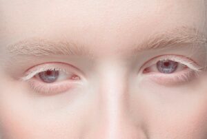 ¿existe albinismo ocular?